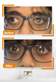 افضل انواع العدسات للمياه البيضاء 