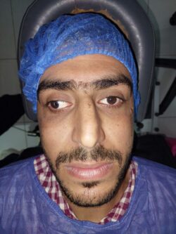 علاج حول العين للكبار
