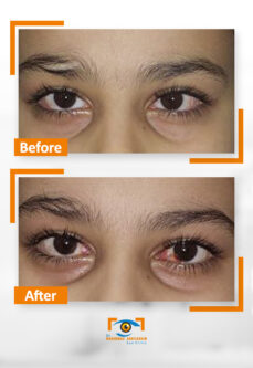 اسباب ظهور الماء الابيض في العين 