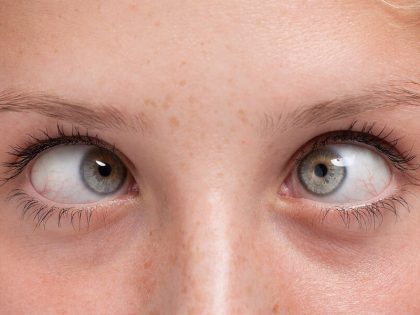 تصحيح انحراف العين