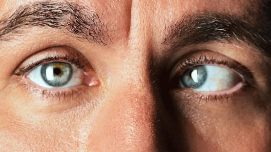 علاج الحول الإنسي عند الكبار