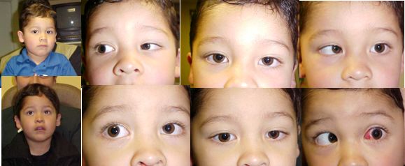 أسباب حول العين 