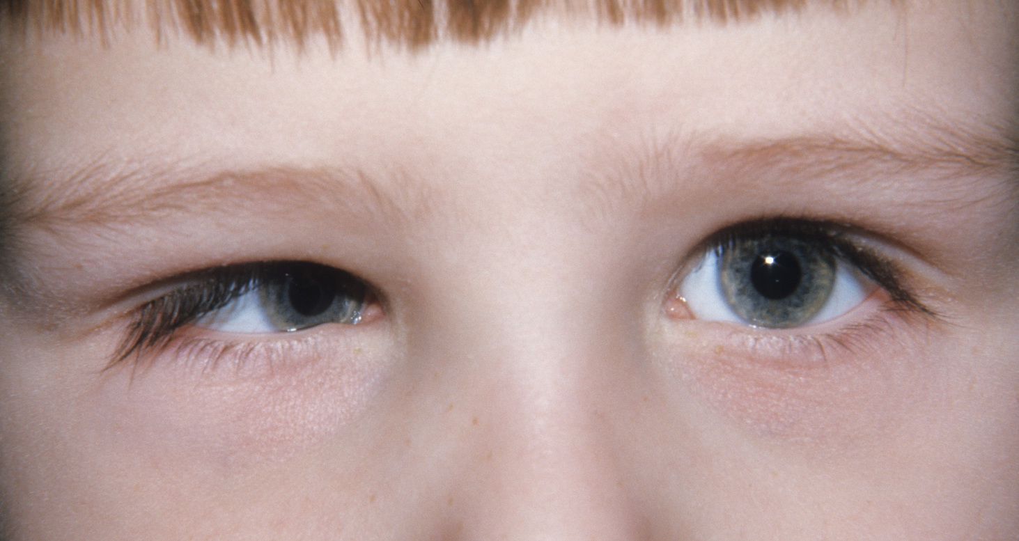 أسباب حول العين عند الأطفال مع د. محمد عبد الكريم | المحلة الكبرى