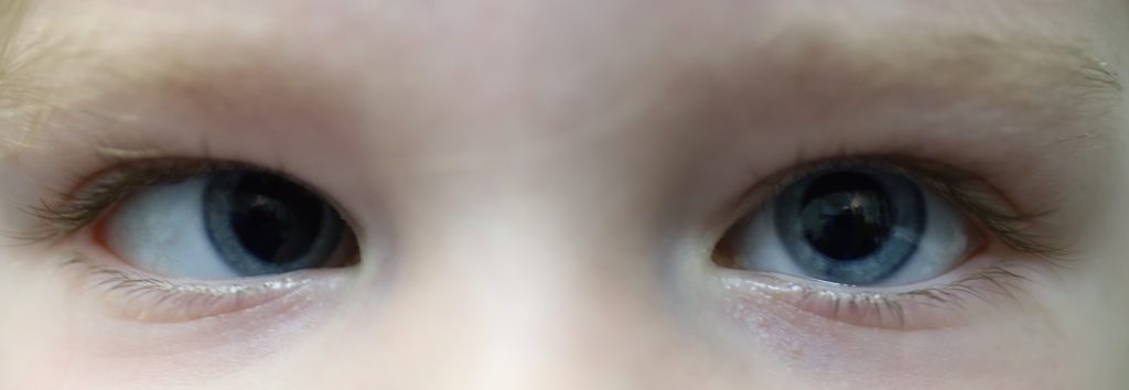 اعراض حول العين