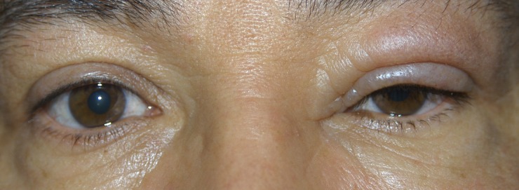 الانتفاخ فوق العين