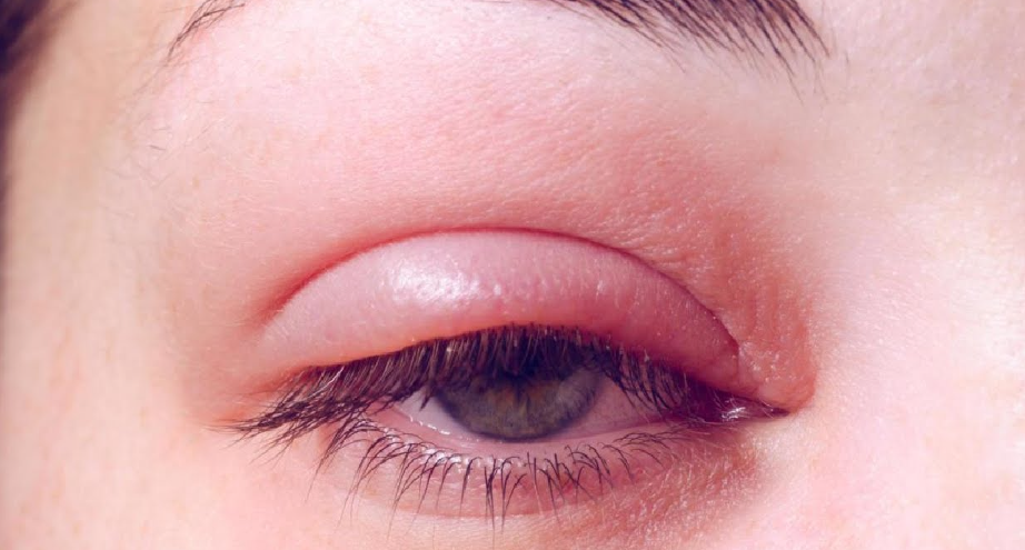 أسباب الانتفاخ فوق العين وطرق علاجه مع د. محمد عبد الكريم | المحلة الكبرى