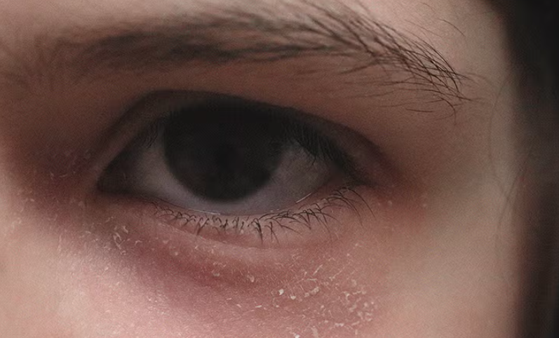 جفاف حول العين للاطفال الأسباب والعلاج مع د. محمد عبد الكريم | المحلة الكبرى