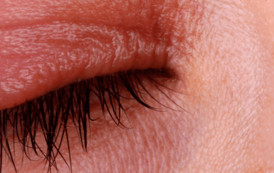 تشخيص وعلاج سبب الاحمرار حول العين مع د. محمد عبد الكريم | المحلة الكبرى