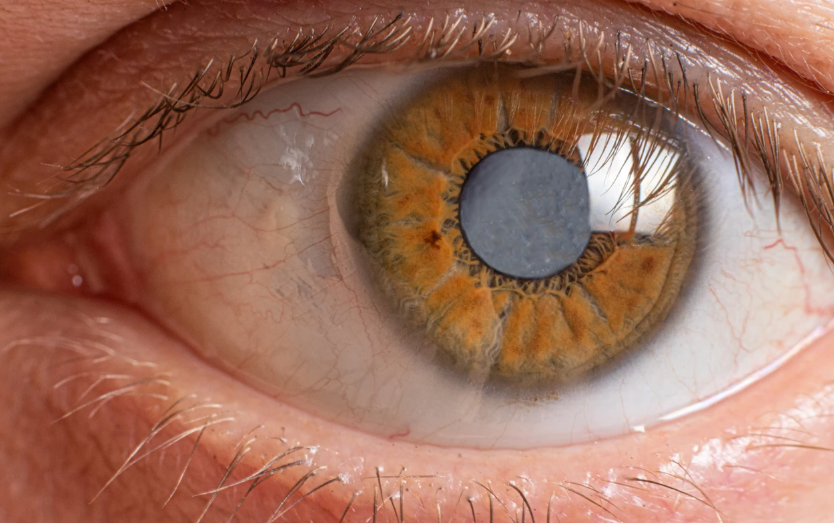 عملية الماء البيضاء في العين